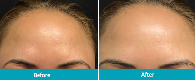 Forehead Lines & Frown Lines Before & After Photos New Jersey