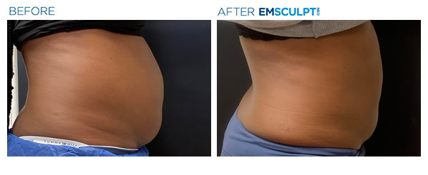 emsculpt neo before and after