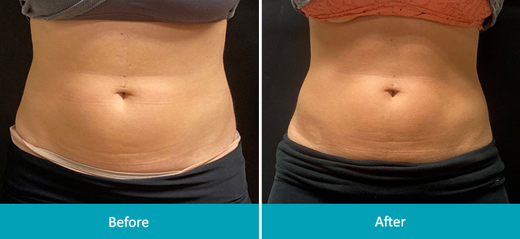EMSCULPT BEFORE AND AFTER, REAL PATIENT RESULTS